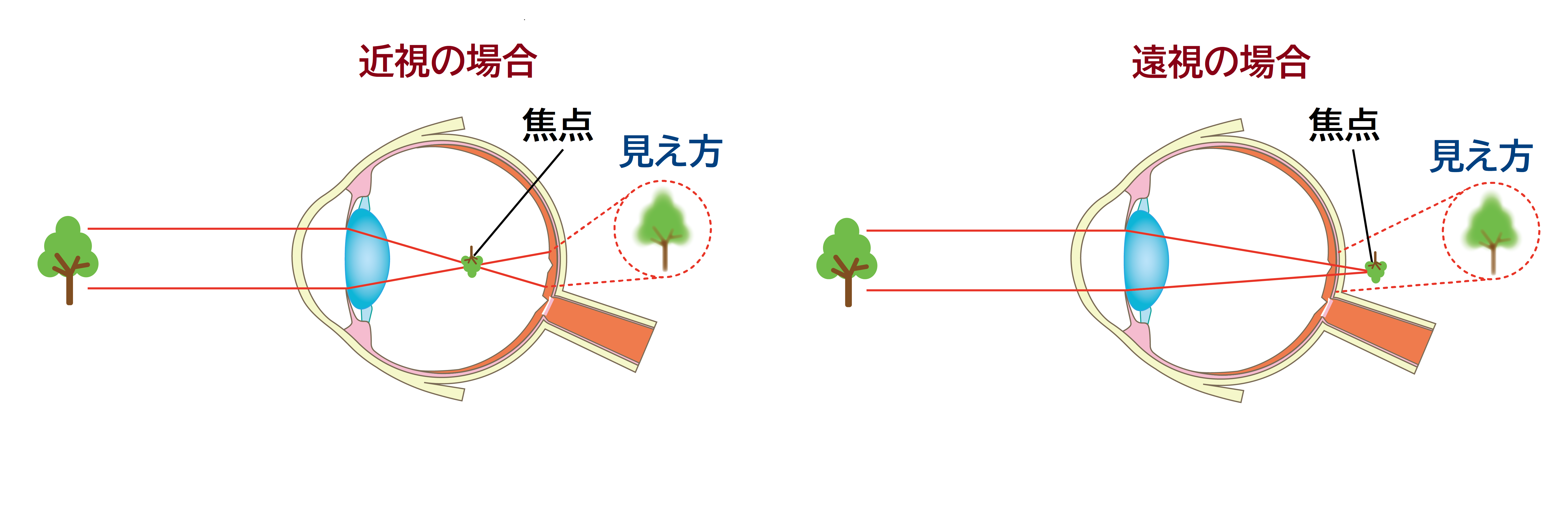 遠視の長期的な見通し